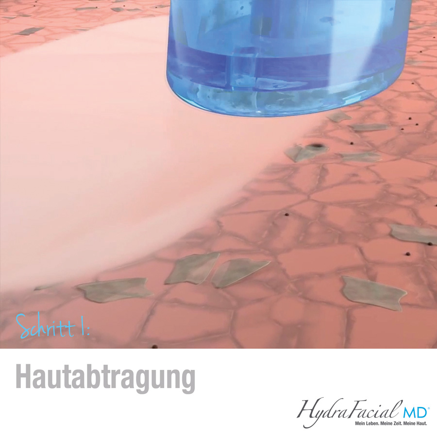 HydraFacial trägt im ersten Schritt abgestorbene Haut ab.