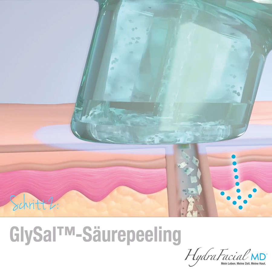 HydraFaciall Glysal Säurepeeling löst Unreinheiten aus der Haut.