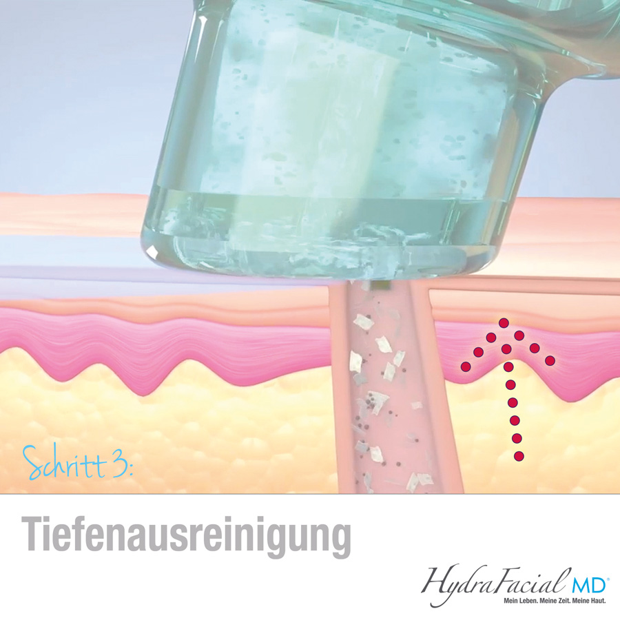 Mit der Hydrafacial Tiefenausreinigung werden Unreinheiten aus den Poren herausgezogen.